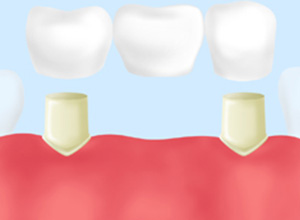 両隣の歯を削って固定するブリッジ治療