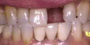 1歯欠損治療写真