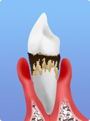 全身の健康をむしばむ歯周病菌の恐怖