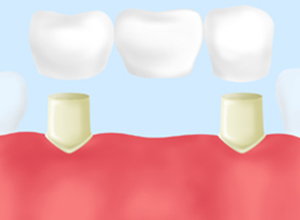 ブリッジ治療の場合