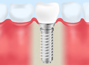 インプラント治療の場合