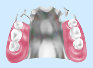 金属床入れ歯