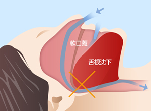 睡眠時無呼吸症候群の状態