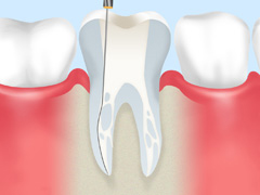 重度のむし歯治療には「根管治療」