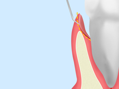 歯周ポケット掻爬(そうは)術