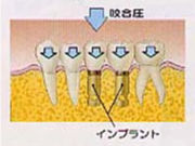 インプラント