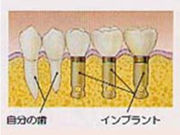 インプラント