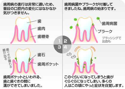 歯周病の原因